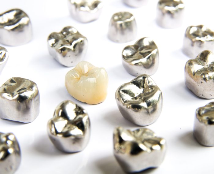 Full Cast Dental Restorations